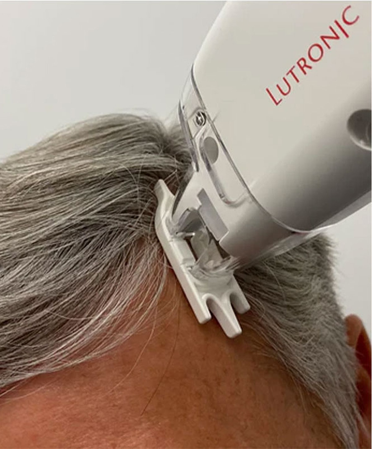 Lutronic device applying treatment on gray hair.