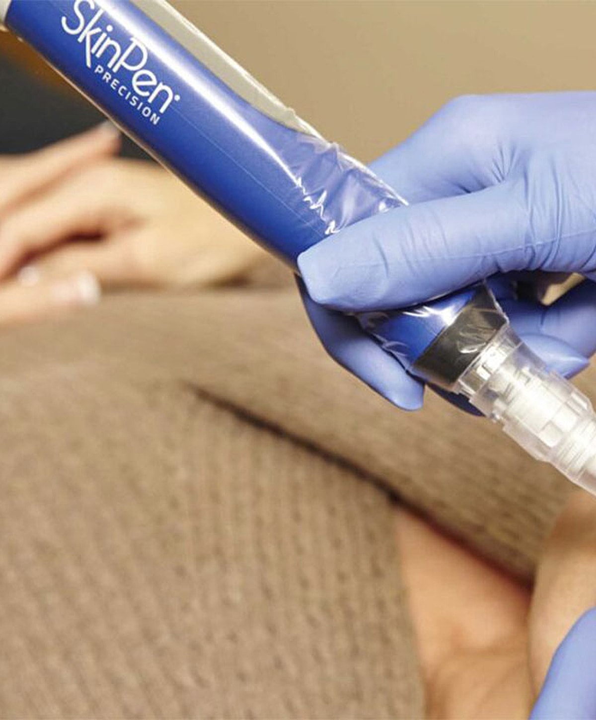 SkinPen microneedling treatment in progress.