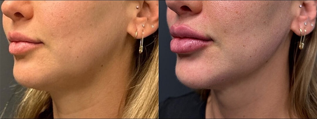 Ha Fillers Before & After