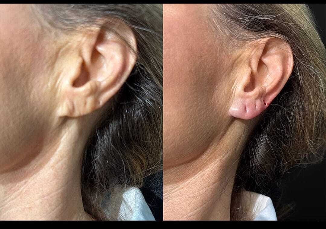 Ha Fillers Before & After
