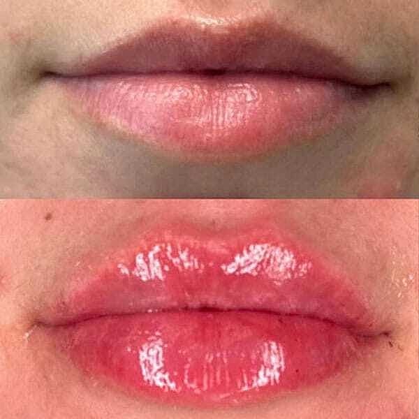 Ha Fillers Before & After