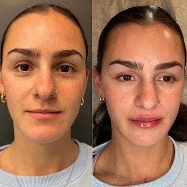 Ha Fillers Before & After