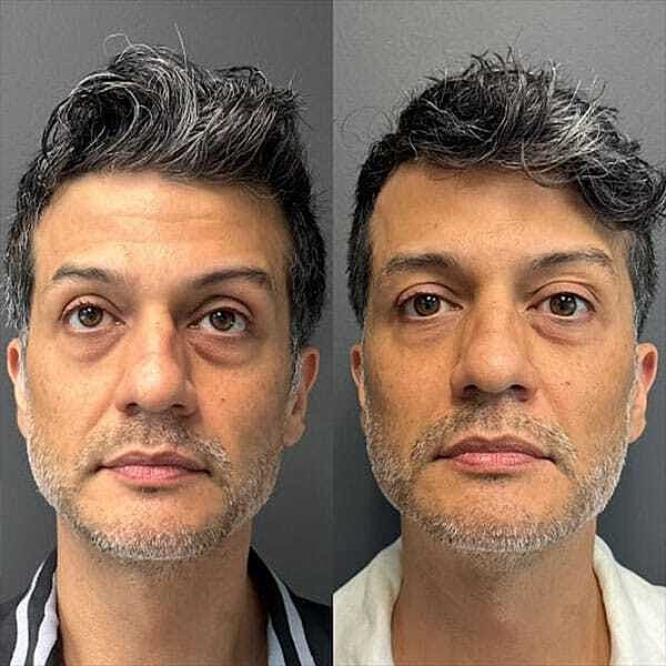 Ha Fillers Before & After