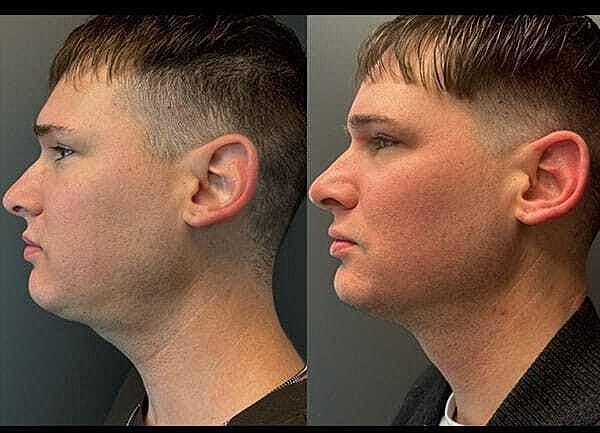 Jawline Contouring Before & After