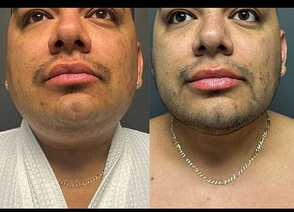 Jawline Contouring Before & After