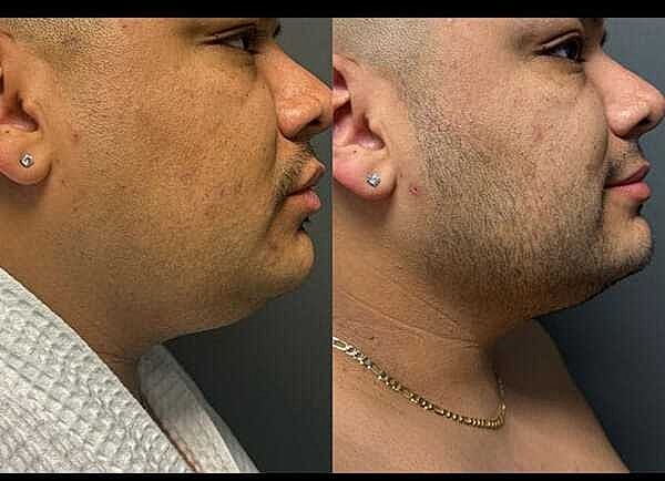 Jawline Contouring Before & After