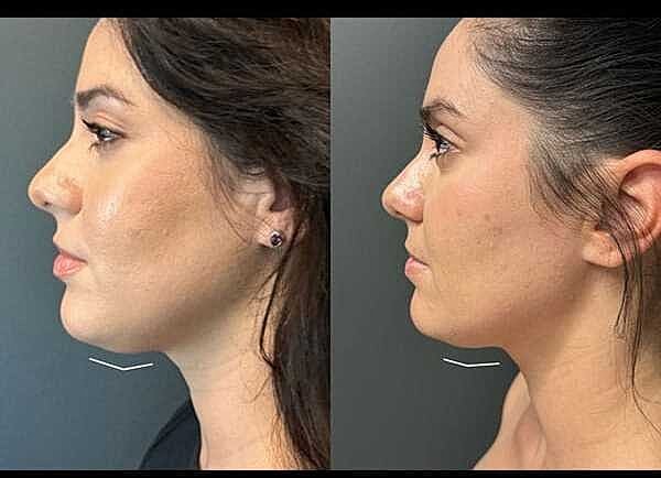 Jawline Contouring Before & After