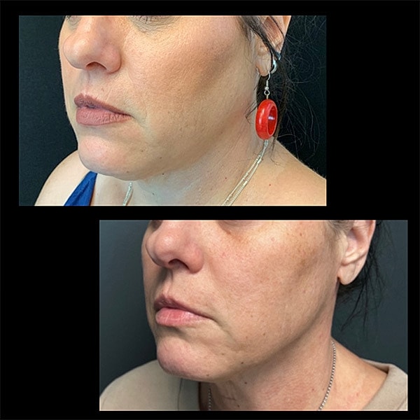 Jawline Contouring Before & After