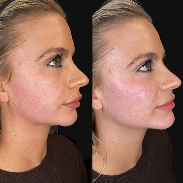 Jawline Contouring Before & After
