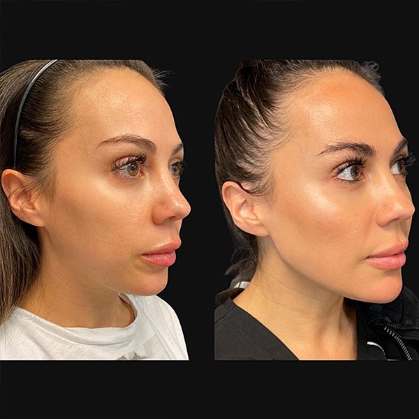Jawline Contouring Before & After