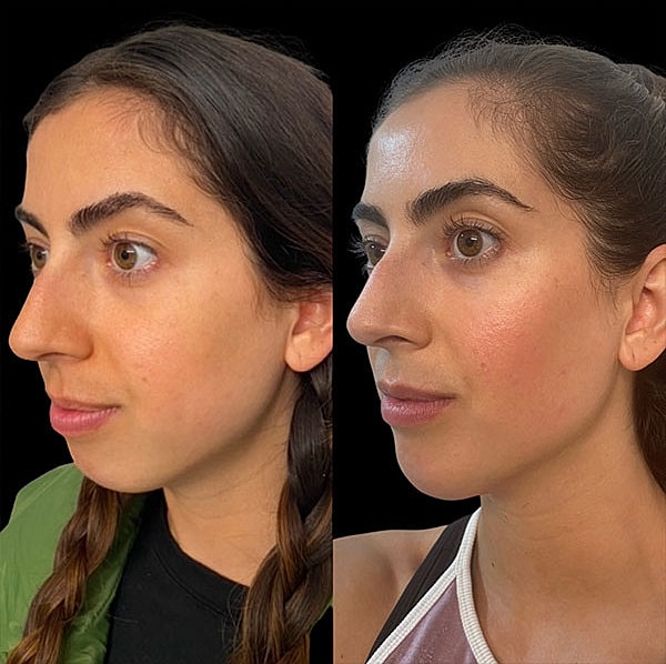 Jawline Contouring Before & After