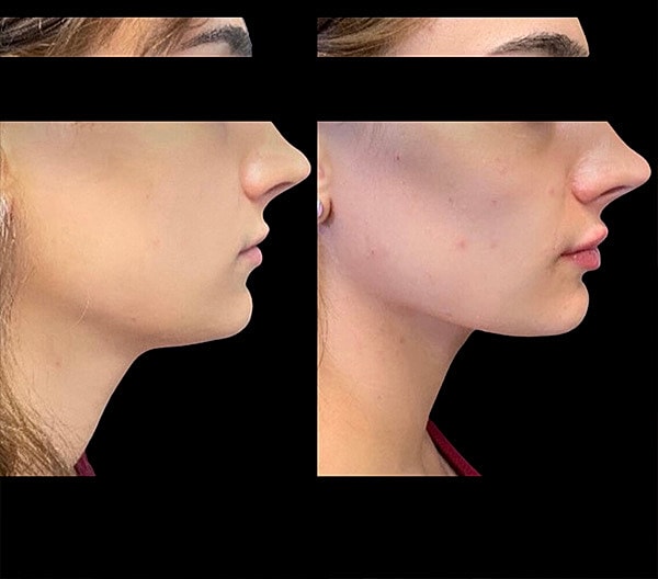 Jawline Contouring Before & After