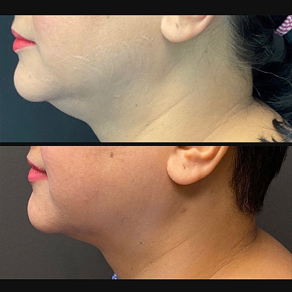 Jawline Contouring Before & After