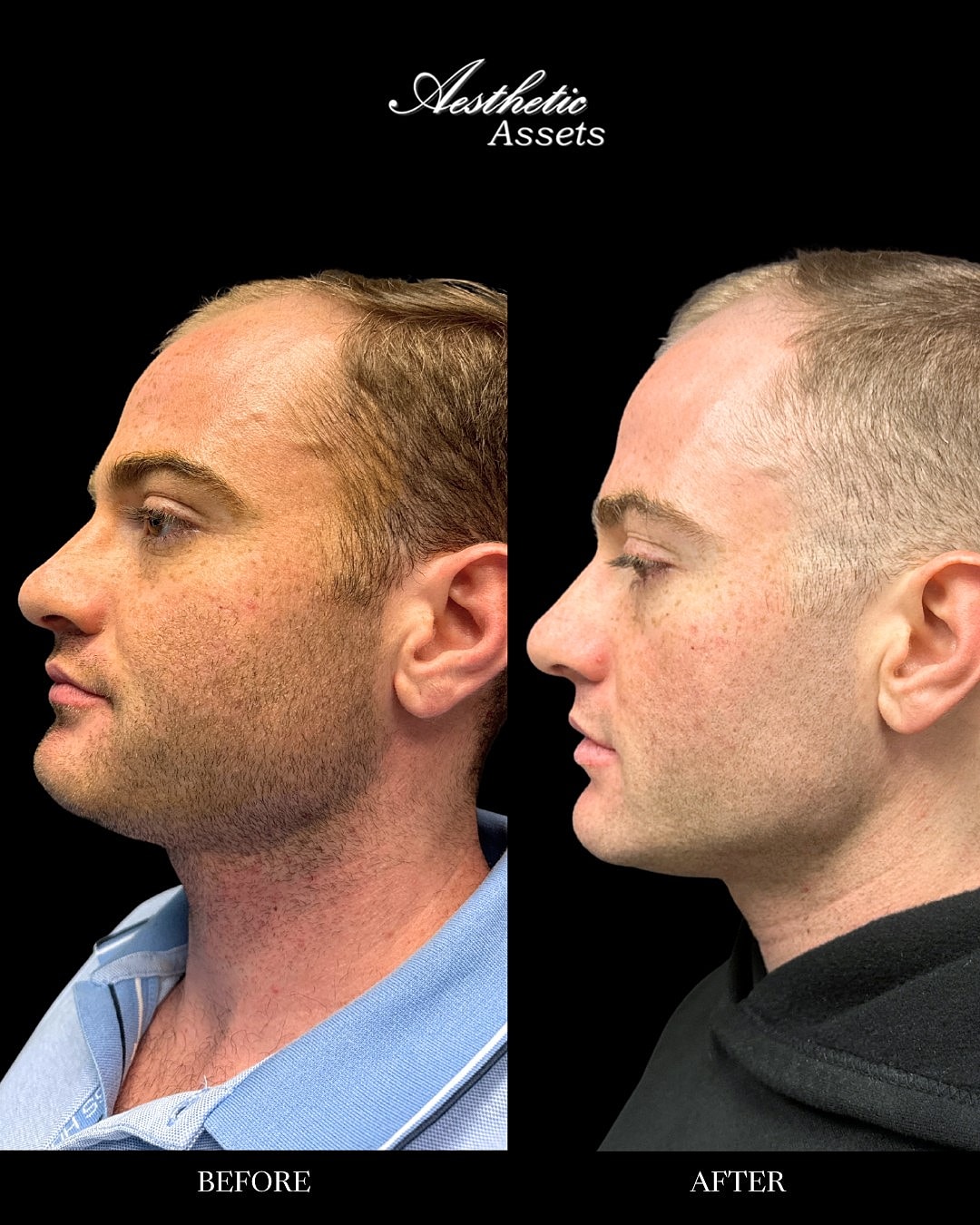 Jawline Contouring Before & After