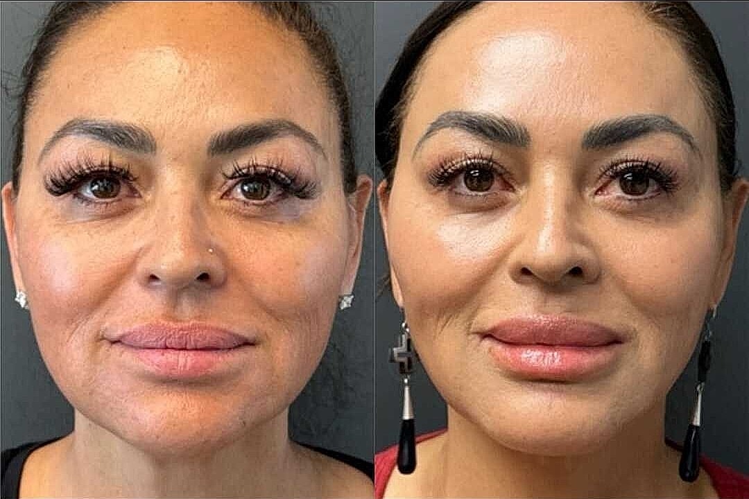 Non Surgical Facelift Before & After