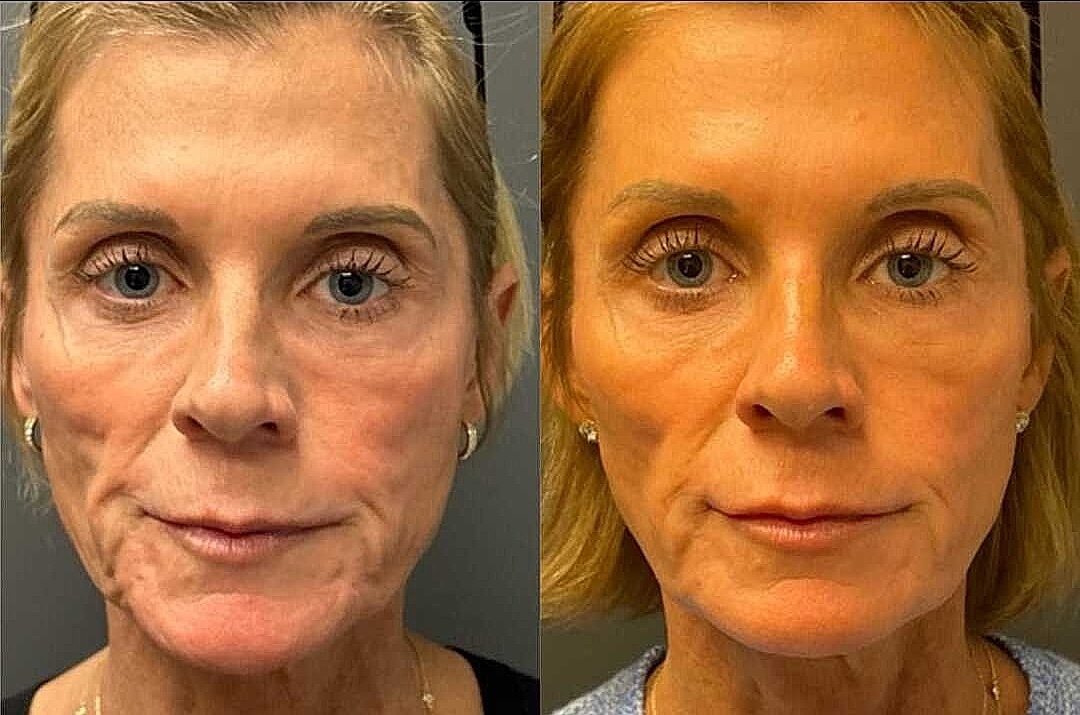 Non Surgical Facelift Before & After