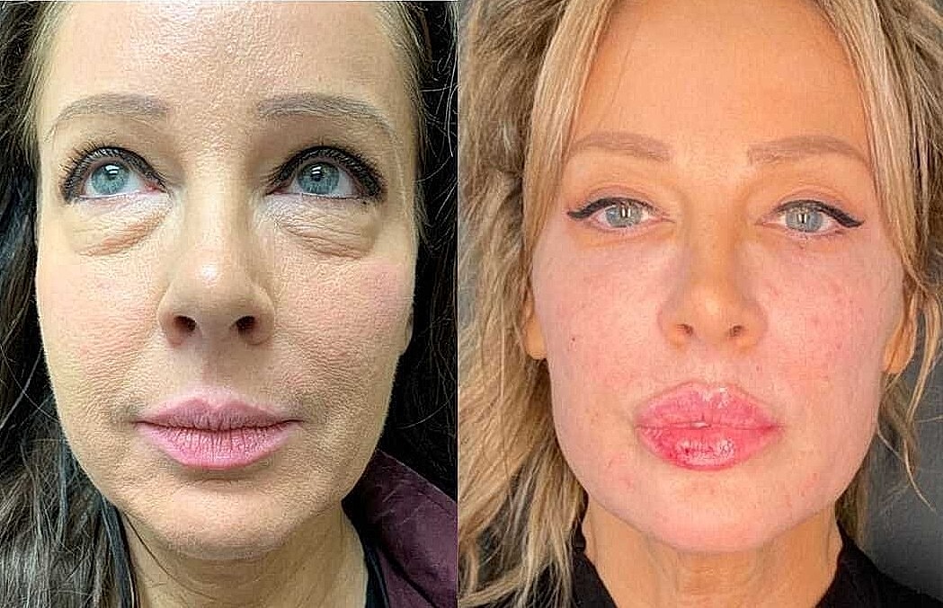 Non Surgical Facelift Before & After