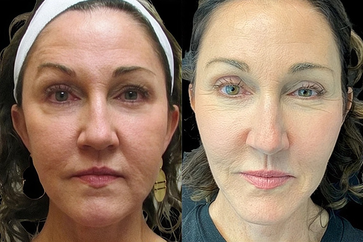 Non Surgical Facelift Before & After