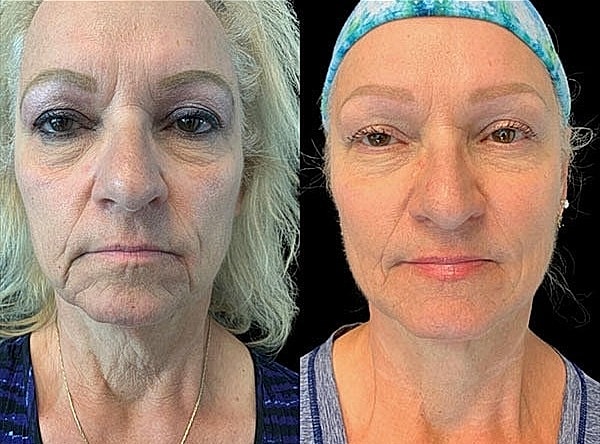 Non Surgical Facelift Before & After