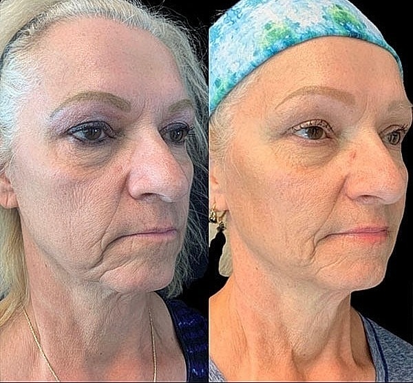 Non Surgical Facelift Before & After