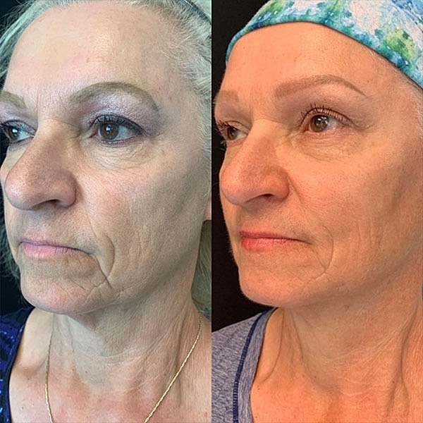 Non Surgical Facelift Before & After