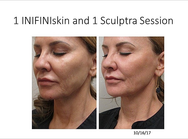 Non Surgical Facelift Before & After