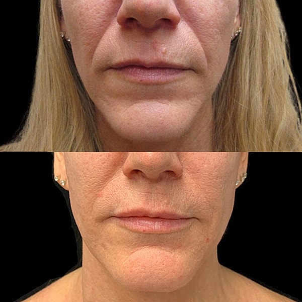 Non Surgical Facelift Before & After