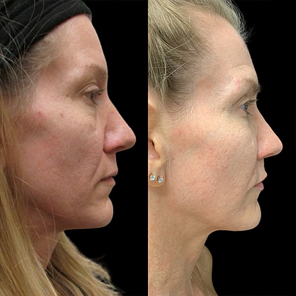 Non Surgical Facelift Before & After