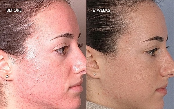 Non Surgical Facelift Before & After