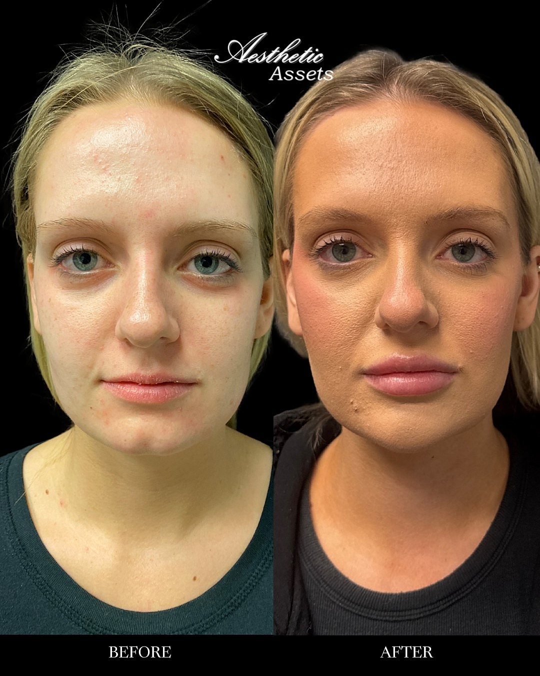 Facial Balancing Before & After