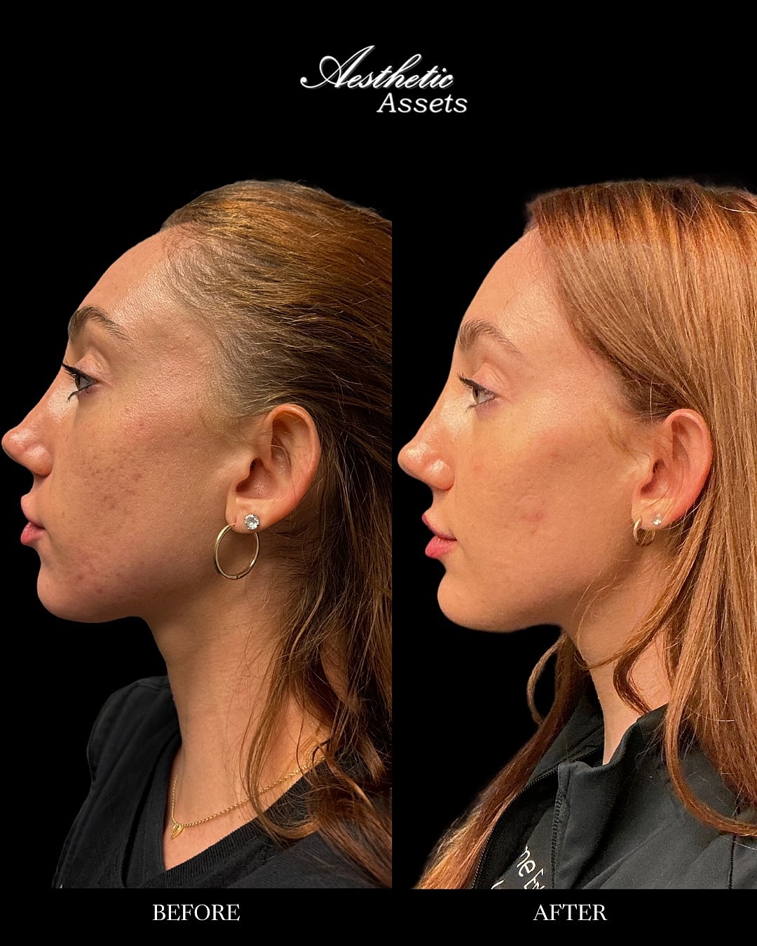 Facial Balancing Before & After