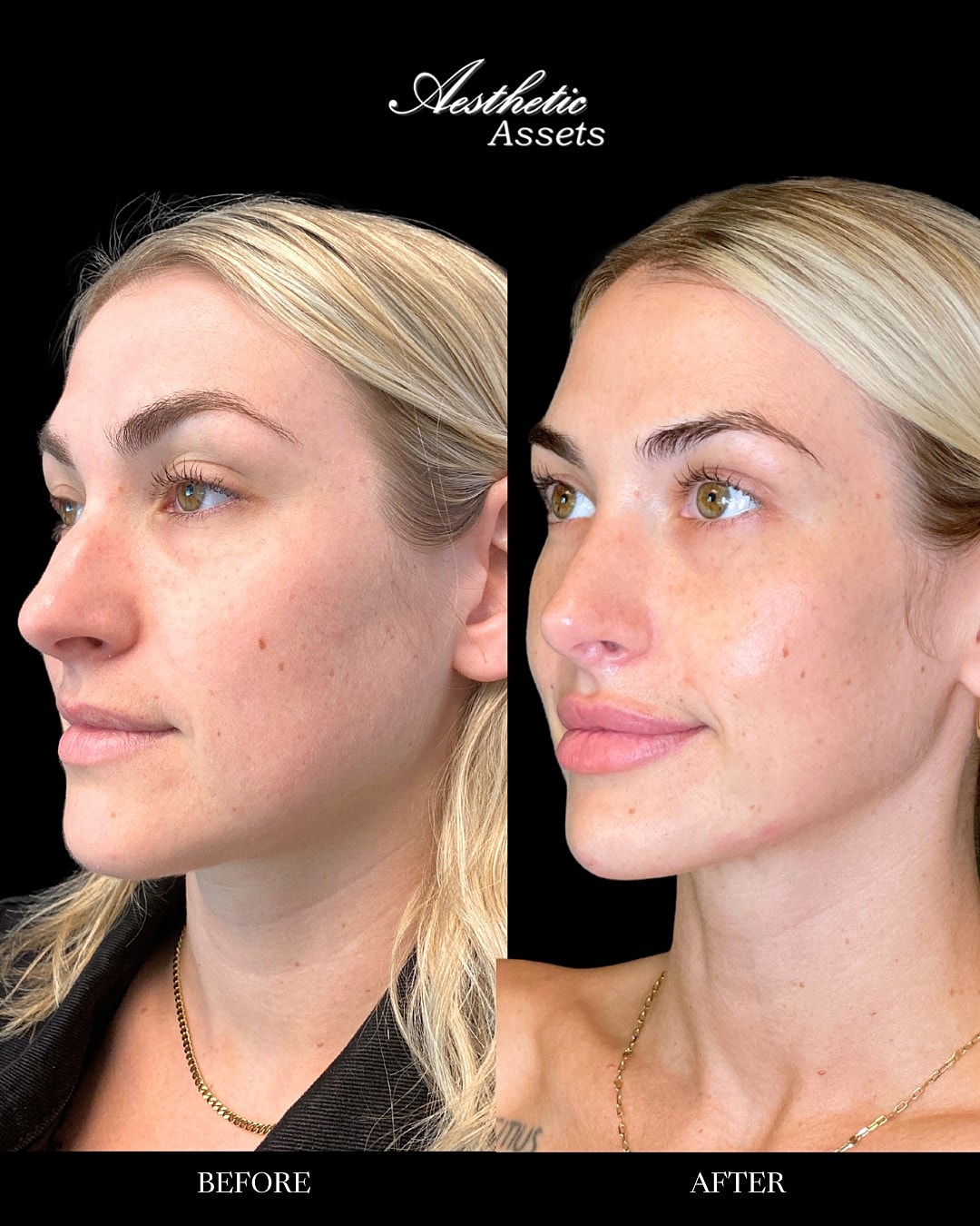 Facial Balancing Before & After