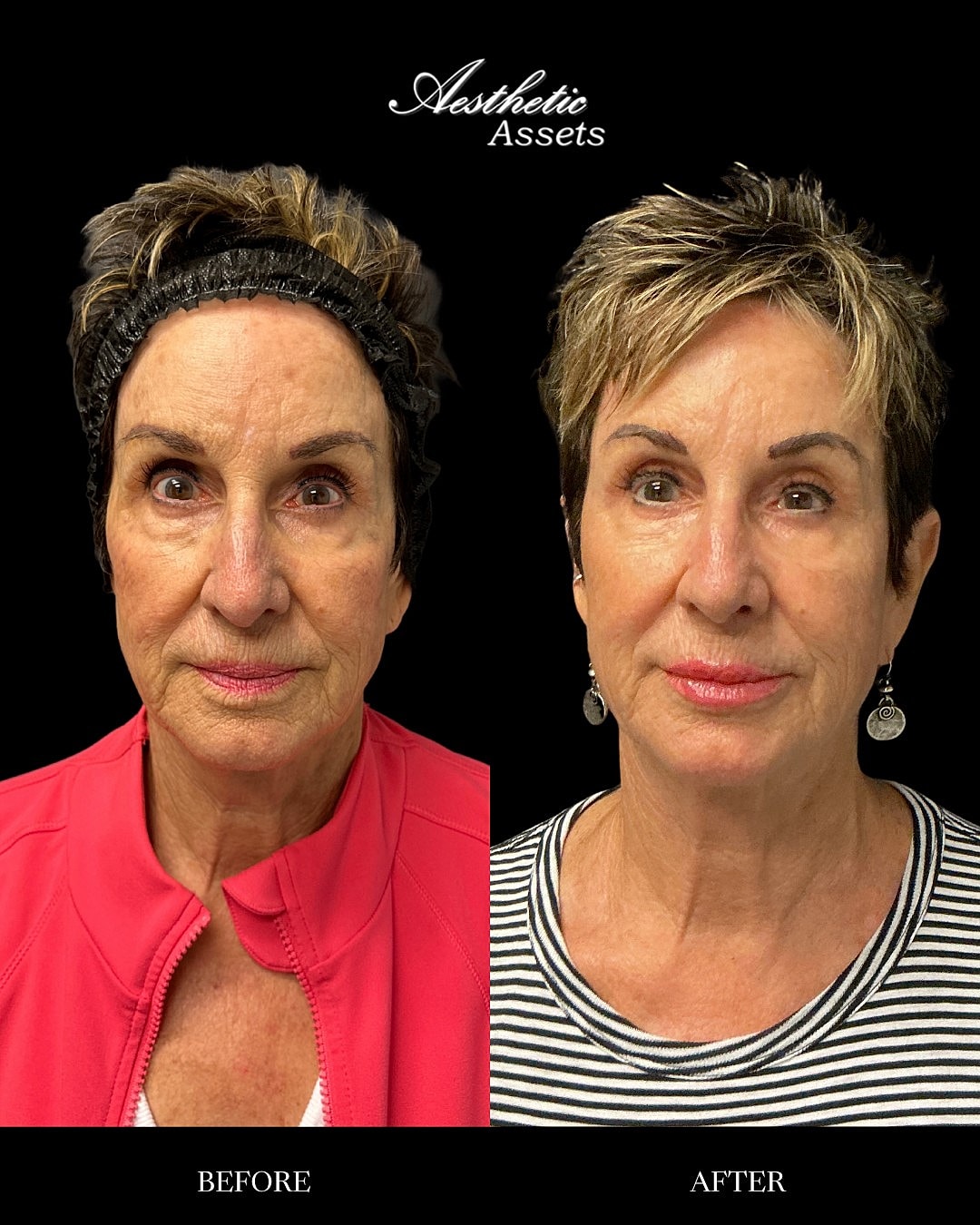 Facial Balancing Before & After