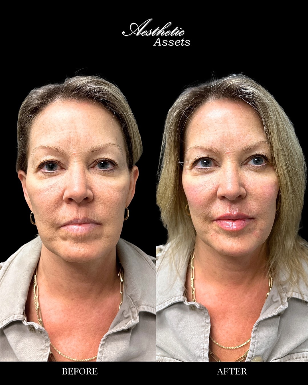 Facial Balancing Before & After