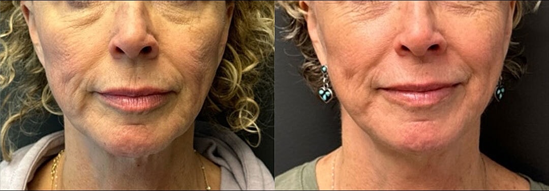 Sculptra Before & After