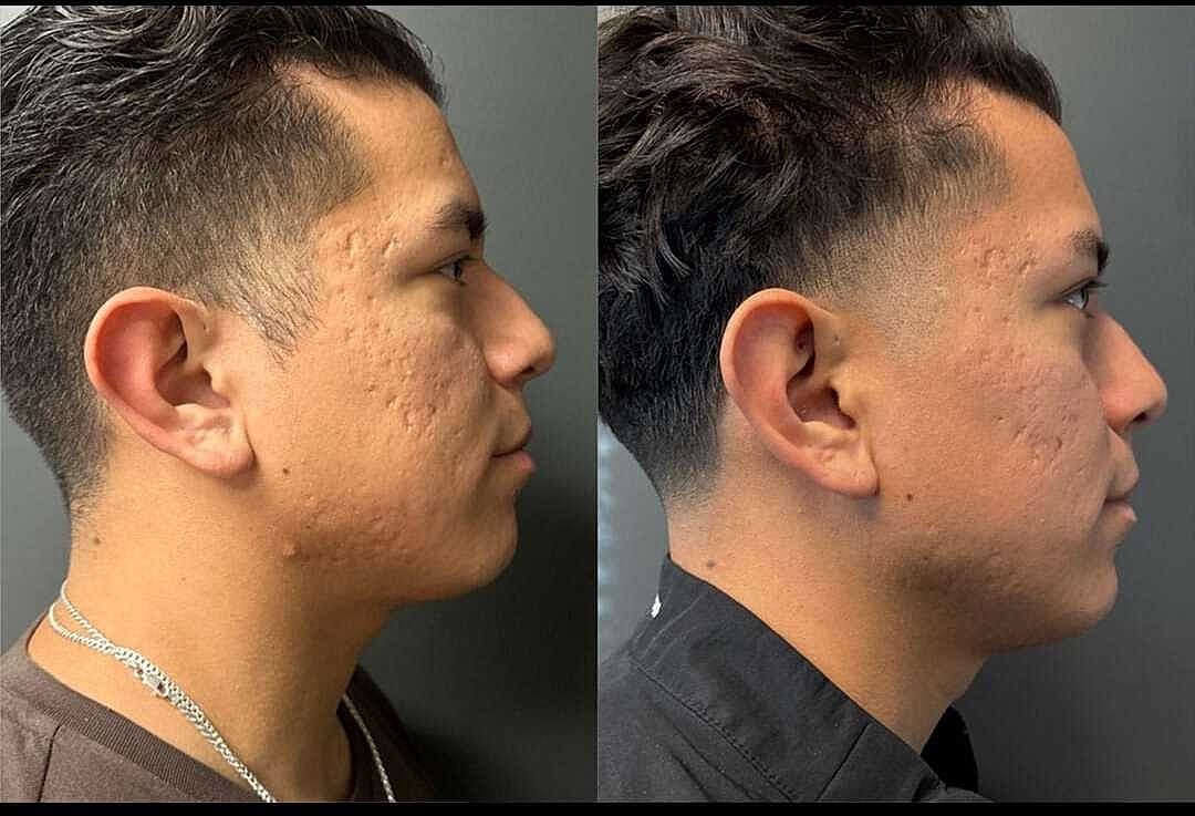 Acne Scarring Before & After
