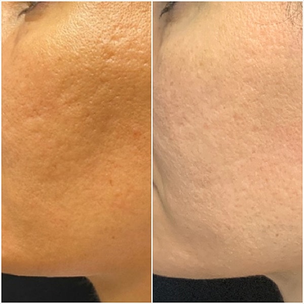 Acne Scarring Before & After