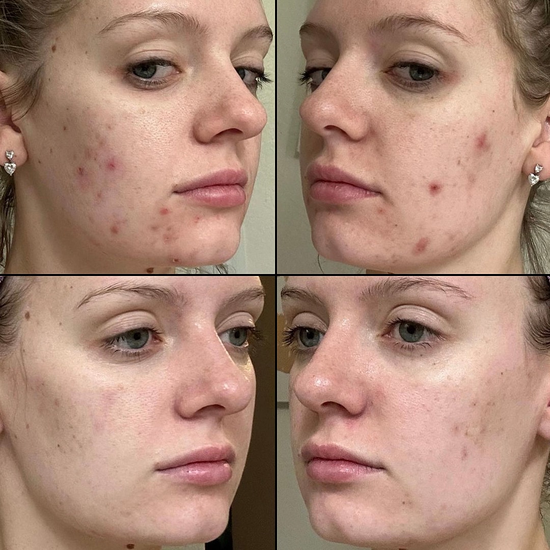 Acne Scarring Before & After