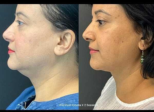 Double Chin Before & After
