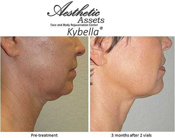 Double Chin Before & After