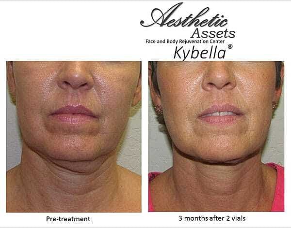 Double Chin Before & After