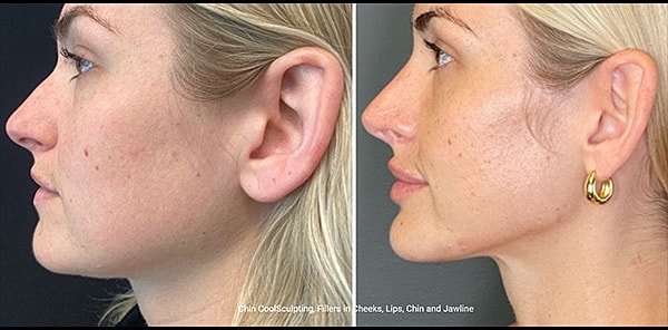 Double Chin Before & After
