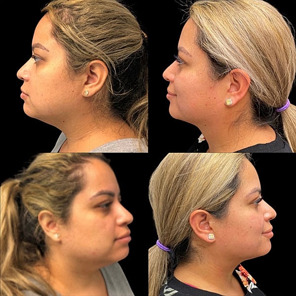Double Chin Before & After