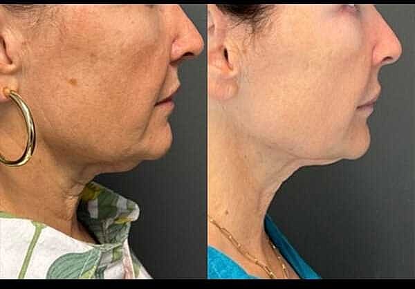Double Chin Before & After