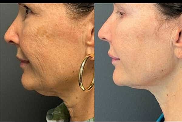 Double Chin Before & After