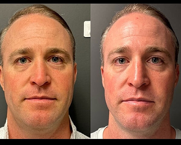 Rf Microneedling Before & After