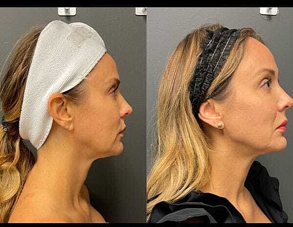Rf Microneedling Before & After