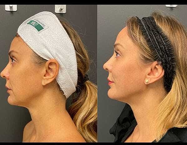 Rf Microneedling Before & After