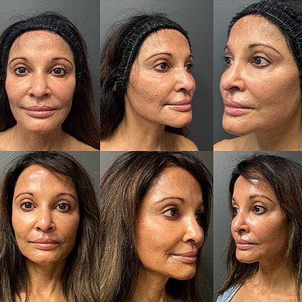 Rf Microneedling Before & After