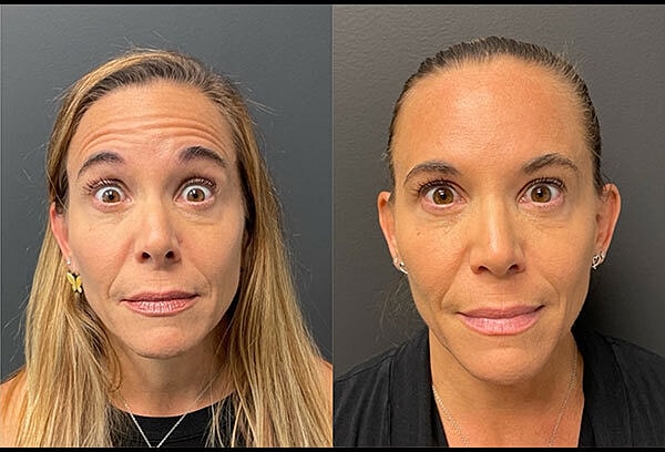 Biostimulators Before & After